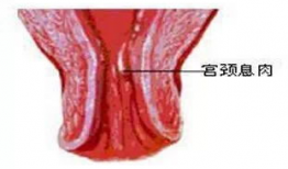 宫颈息肉可以吃茄瓜,营养食疗新选择