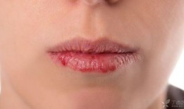 吃瓜嘴角刺痛,揭秘背后原因及预防措施