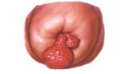 宫颈息肉可以吃茄瓜,营养食疗新选择